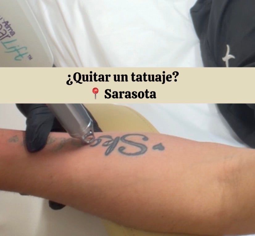 Eliminación de tatuajes en Sarasota