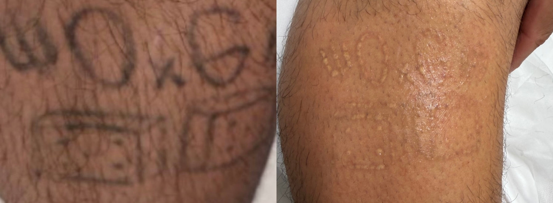Bradenton Tattoo Removal