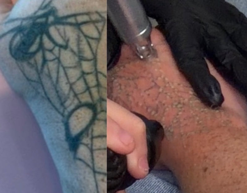 Affordable Tattoo Removal Sarasota