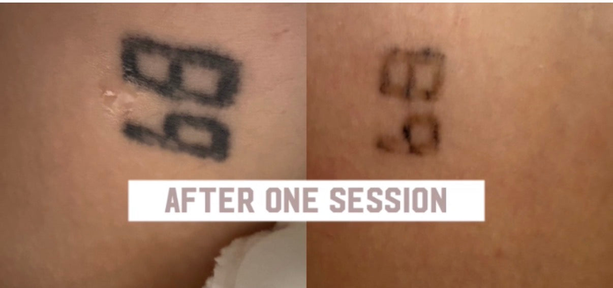 Best Tattoo Removal Bradenton